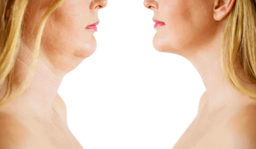 Double Chin treatment Kilburn before and after results