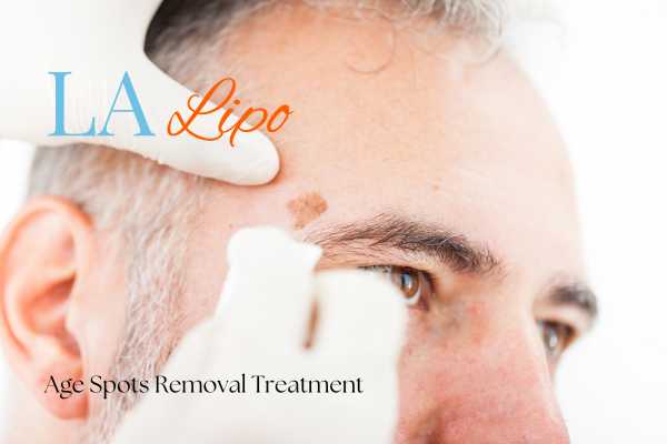 What Are the Most Effective Treatments for Age Spots Kilburn?
