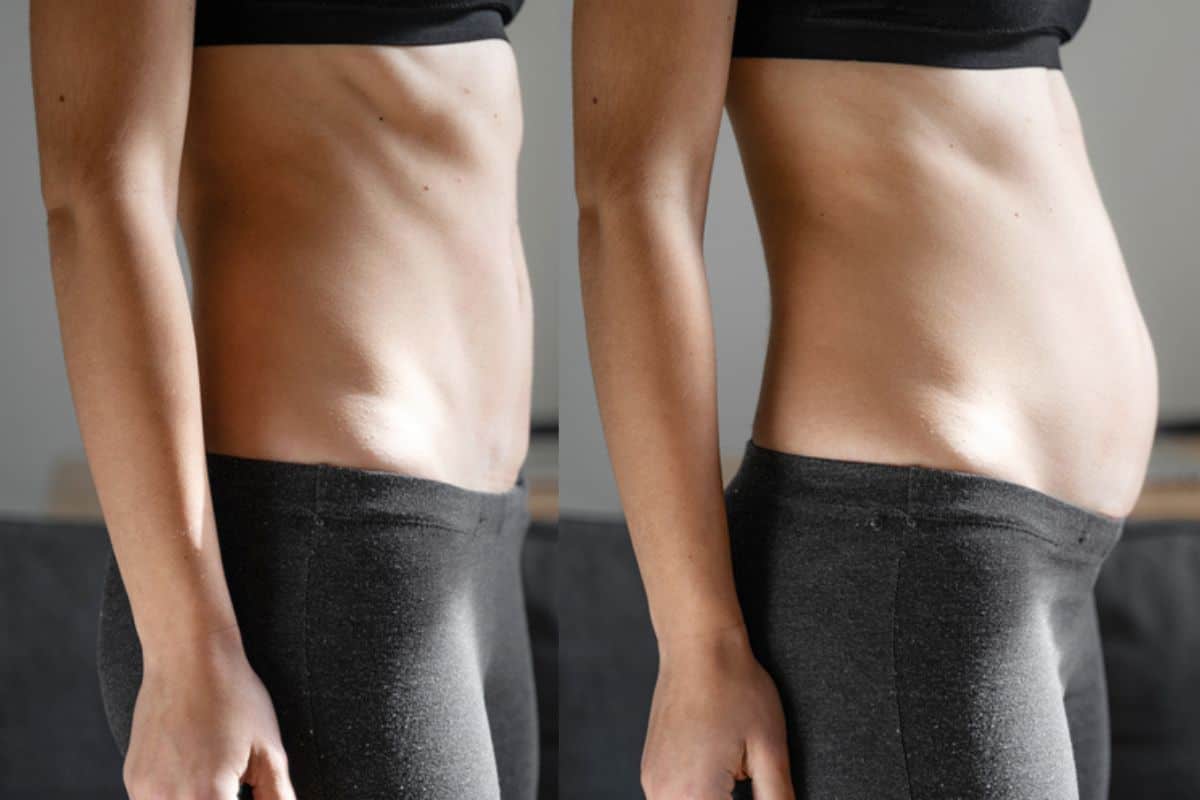 How long does diastasis recti take to improve Kilburn?