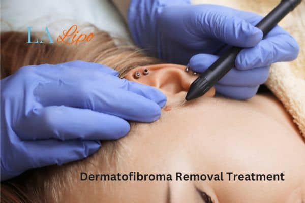 Dermatofibroma Removal Treatment Kilburn