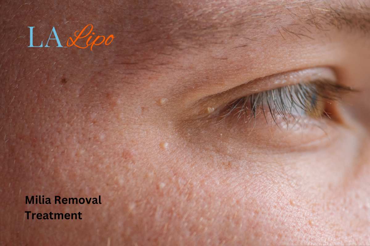 Cryopen Milia Removal: Is It the Easiest and Safest Option Kilburn?