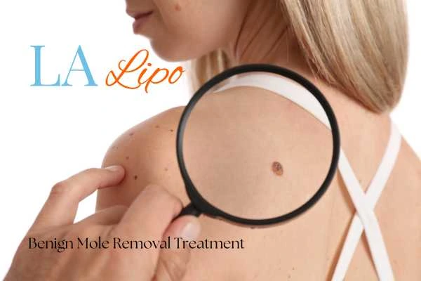 Why getting moles removed Kilburn can boost your confidence!