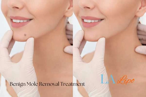 Woman's before and after results of being moles removal treatment Kilburn
