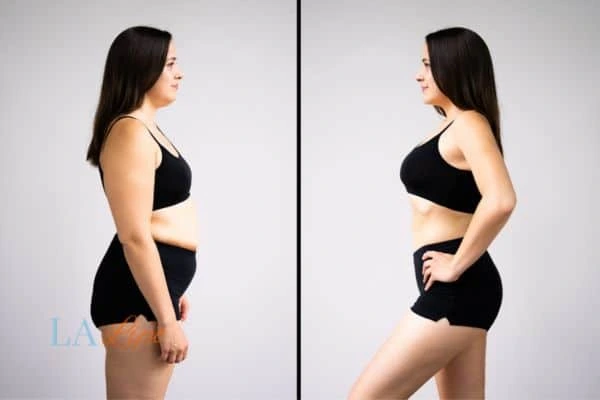 LA-EMS Body Sculpting Kilburn results before and after of womans results on body toning.