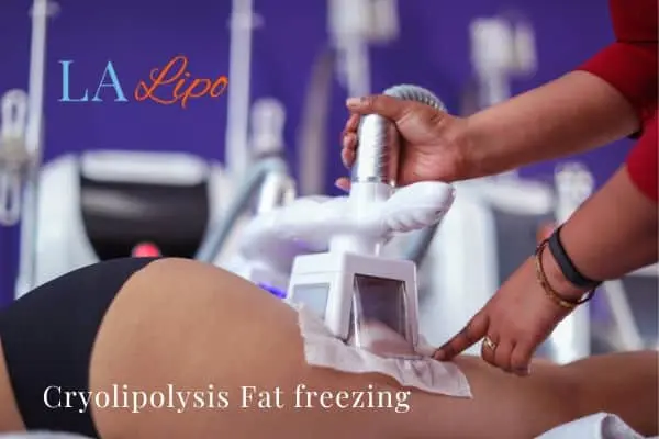 women getting fat freezing Kilburn