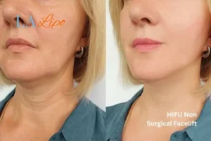 hi-fu for wrinkles Kilburn before and after results