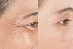 Before and after results of woman - HI-fu wrinkles reduction treatment Kilburn