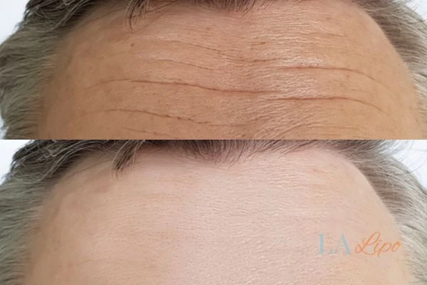 results of HIFU Kilburn on mans forehead to help reduce lines and wrinkles