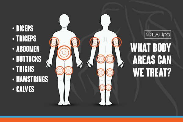 Graphic to show areas you can have LA-EMS Body Sculpting Kilburn treatment.