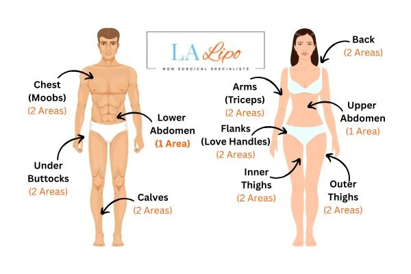 LA LIPO Cryolipolysis Areas Kilburn