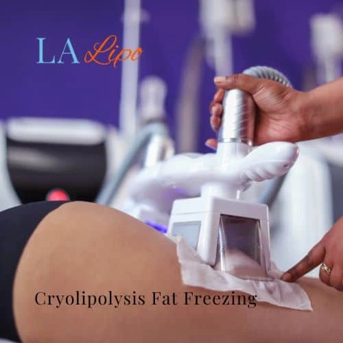fat freezing - Cryolipolysis Kilburn