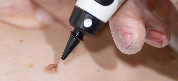 skin tag removal using cryopen Kilburn