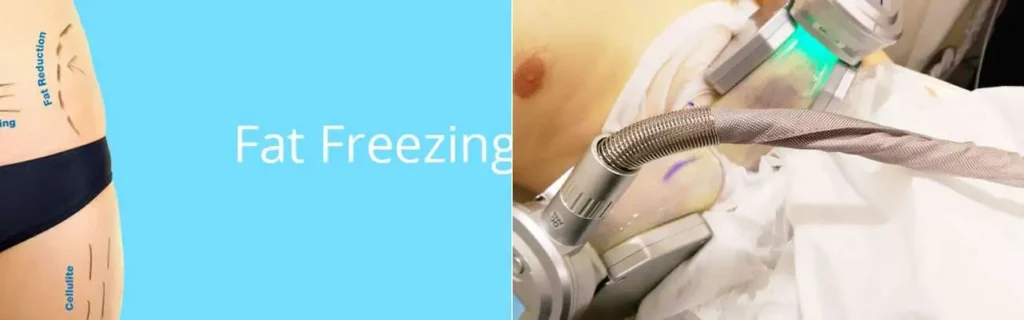 multi areas of a persons body having coolsculpting Kilburn treatment