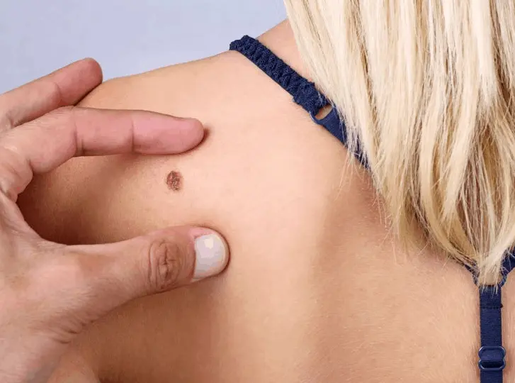 woman having mole removal Kilburn consultation before treatment.