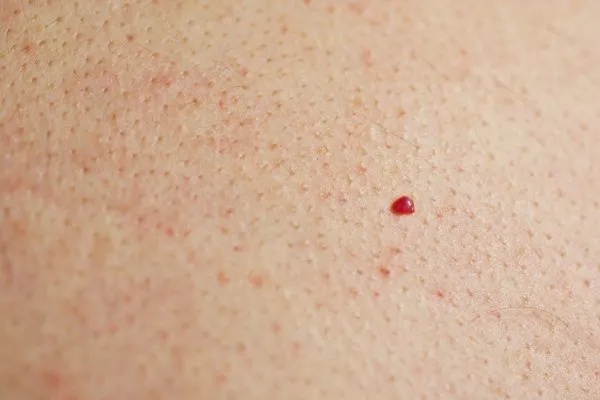 close up of a cherry angioma Kilburn