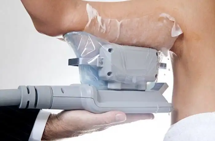 Picture of fat freezing Kilburn on the upper arms.