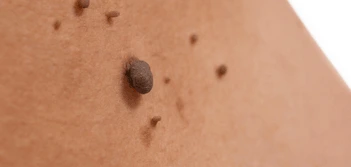 image of a skin tag Kilburn