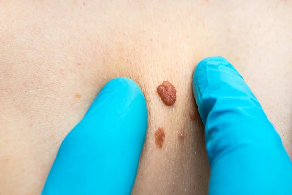 Consultant examining a skin tag Kilburn