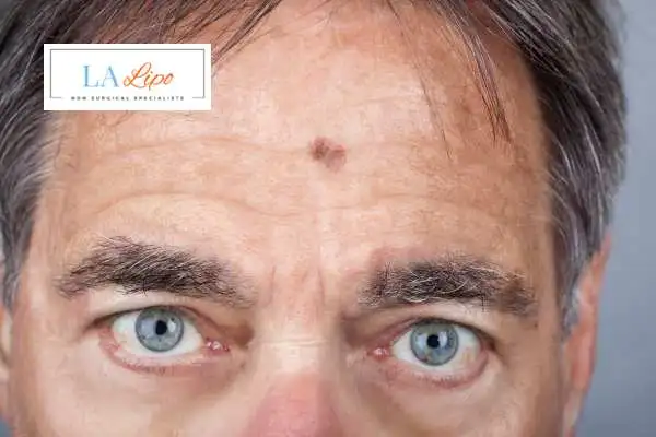 Solar Lentigo Removal Kilburn image of man with mark on his forehead