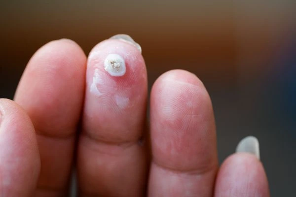wart on person finger - cryotherapy to treat from LA LIPO Kilburn