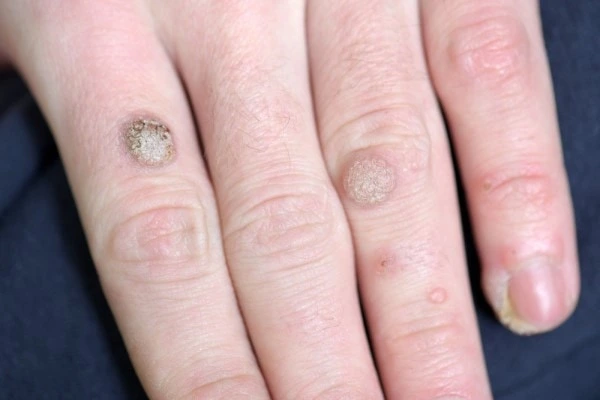 photo of warts on person hand - see wart removal Kilburn from LA LIPO