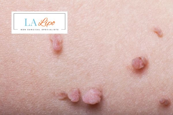 Does cryopen skin tag removal Kilburn hurt? Find out now call our team today!
