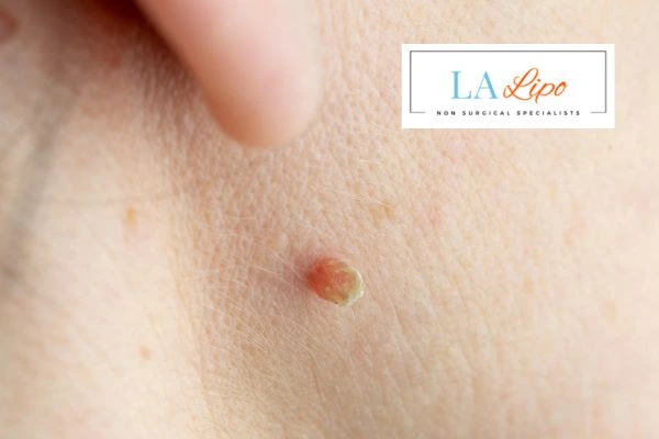 Book skin tag removal Kilburn today speak to our team now!