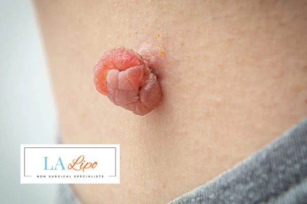 Interested in skin tag removal Kilburn? Concerned about the pain? Find out more today!