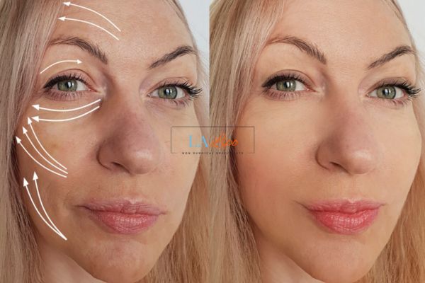 Morpheus 8 results Kilburn face lift.