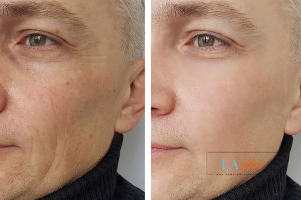 See the amazing results of Morpheus8 Treatment Kilburn!