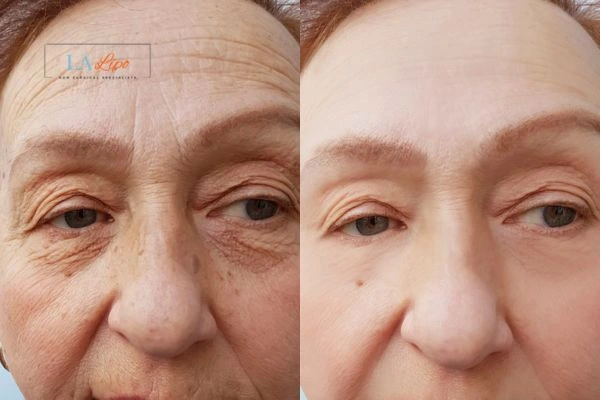 The powerful benefits of Morpheus8 Treatment Kilburn - Call Our team today!