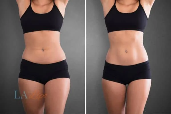 before and after results of non-surgical treatment to help a woman's body image and mental health Kilburn