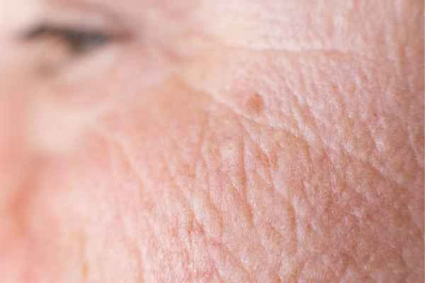 close up picture of a woman's face showing an age spot Kilburn