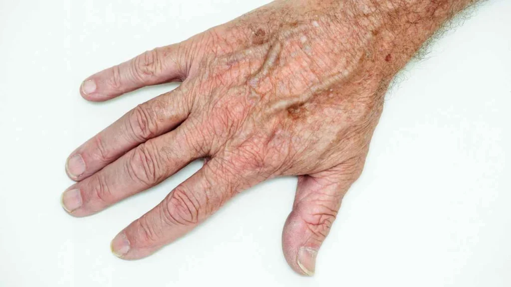 Male hand showing age spot Kilburn