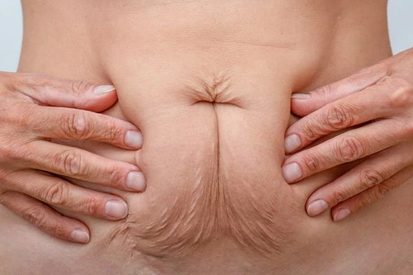 Image of a woman's stomach with loose skin - example of skin tightening Kilburn options