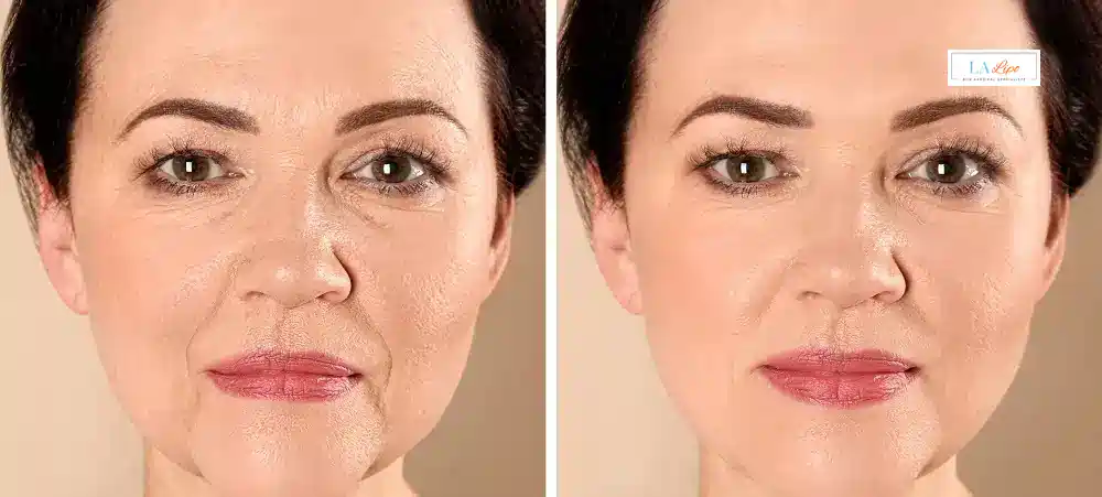 How Long Does It Take to See Results and How Long Do They Last Kilburn?