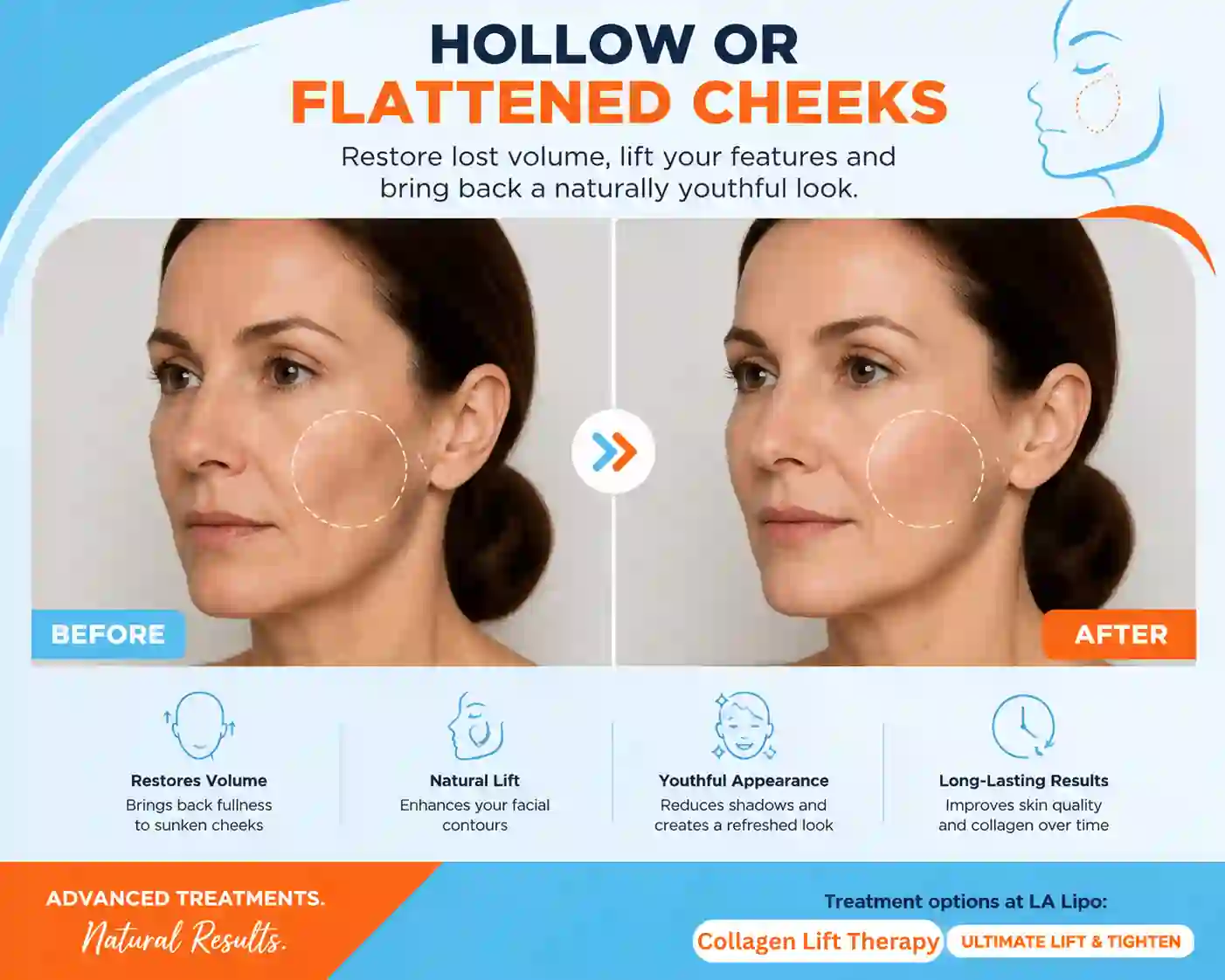 Sign #4: Hollow or Flattened Cheeks Kilburn